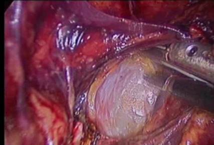 gynecological cancer surgery - 10 the levator ani muscle