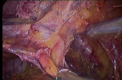 gynecological cancer surgery - 11 dissecting the ureteric tunnel