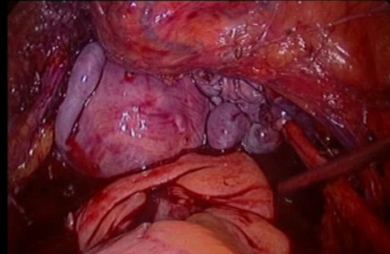 gynecological cancer surgery - 14 vagina cut across to comlete the radical hysterectomy