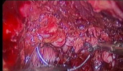 gynecological cancer surgery - 15 vaginal suturing completed