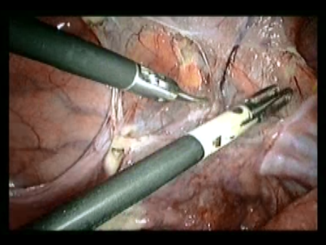 gynecological cancer surgery - 2 opening the lateral pelvic wall
