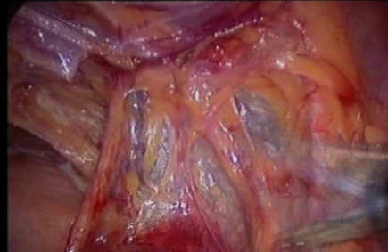 gynecological cancer surgery - 3 dissecting the ureter