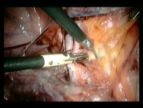 gynecological cancer surgery - 4 pelvic lymphadenectomy