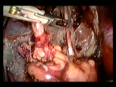 gynecological cancer surgery - 5 dissecting out the obdurator vessels and nerve