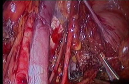 gynecological cancer surgery - 6 exposure of the pelvic vessels and the pubic bone
