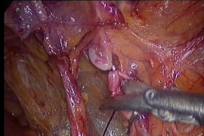 gynecological cancer surgery - 7 clipping and cutting the uterine arteries at the origin from internal iliac artery