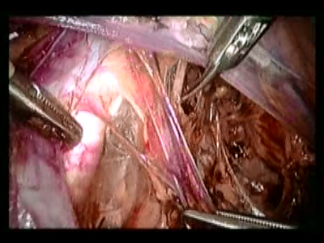 gynecological cancer surgery - 8 dissecting the pelvic nerves