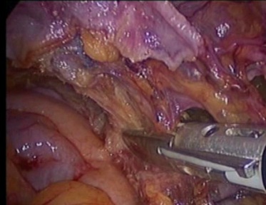 gynecological cancer surgery - 9 dissecting and cutting the parametrium