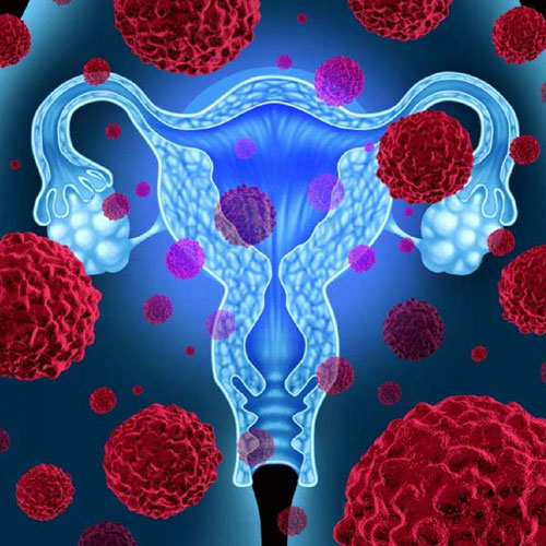 gynecological cancer surgery - gynecological cancer surgery