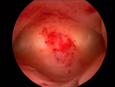 gynecological endoscopy - hysteroscopy - 1 - normal uterine cavity