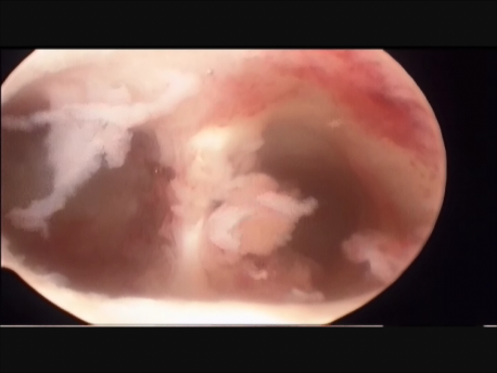 gynecological endoscopy - hysteroscopy - 2 - large uterine septum