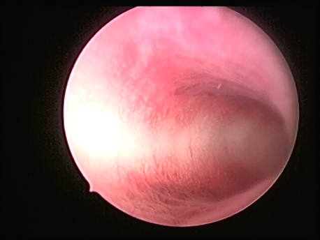 gynecological endoscopy - hysteroscopy - 3 - T shaped uterine cavity