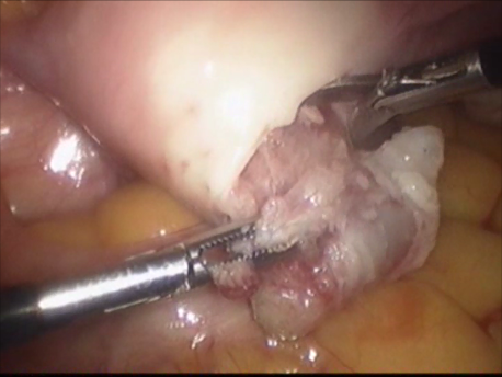 gynecological endoscopy - laparoscopic surgery - excision of interstitial ectopic pregnancy