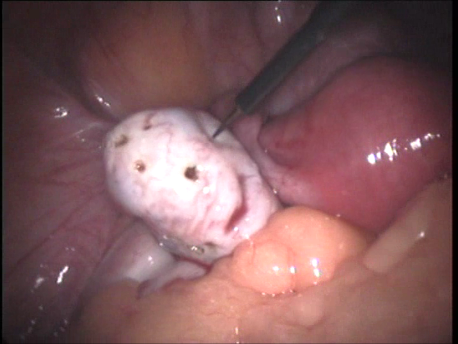 gynecological endoscopy - laparoscopic surgery - laparoscopic ovarian drilling for polycystic ovaries