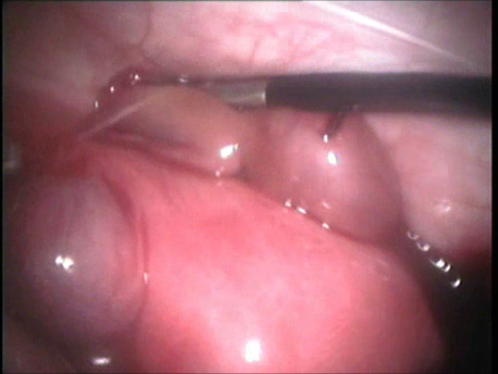 gynecological endoscopy - laparoscopic surgery - large ectopic pregnancy