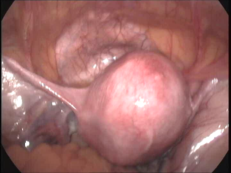 gynecological endoscopy - laparoscopic surgery - large uterine fibroid