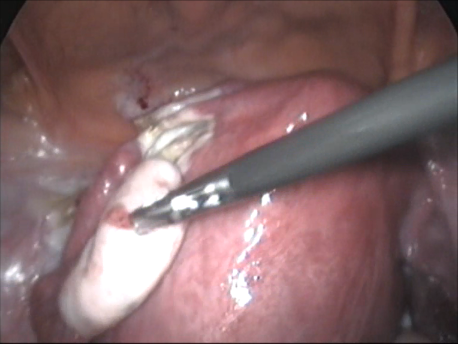 gynecological endoscopy - laparoscopic surgery - large uterus weighing 4kg for laparoscopic hysterectomy