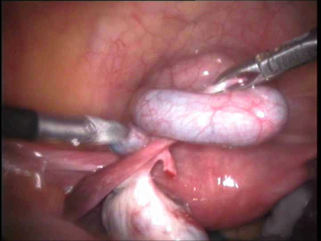 gynecological endoscopy - laparoscopic surgery - left tubal hydrosalpinx