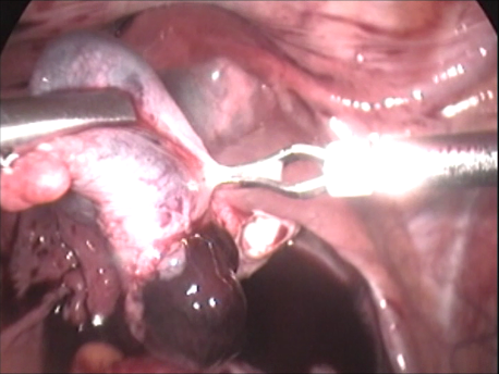 gynecological endoscopy - laparoscopic surgery - salpingectomy for tubal ectopic pregnancy