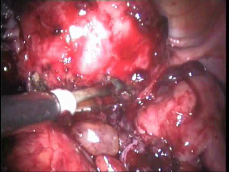 gynecological endoscopy - laparoscopic surgery - severe endometriosis