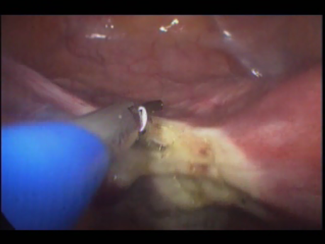gynecological endoscopy - laparoscopic surgery - single port laparoscopic hysterectomy with harmonic scalpel