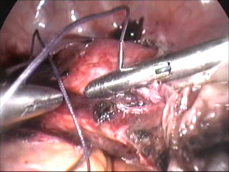 gynecological endoscopy - laparoscopic surgery - suturing of the uterine arteries during laparoscopic hysterectomy