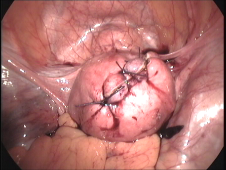 gynecological endoscopy - laparoscopic surgery - suturing of uterus after myomectomy