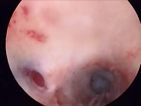 hysteroscopic surgery - 10 - dense intrauterine adhesions