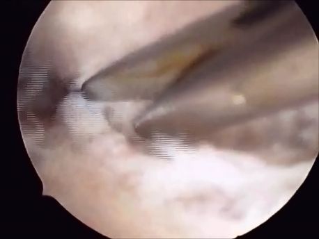 hysteroscopic surgery - 11 - intrauterine adhesions cut with scissors