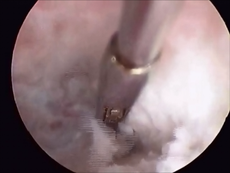 hysteroscopic surgery - 12 - picture after adhesiolysis