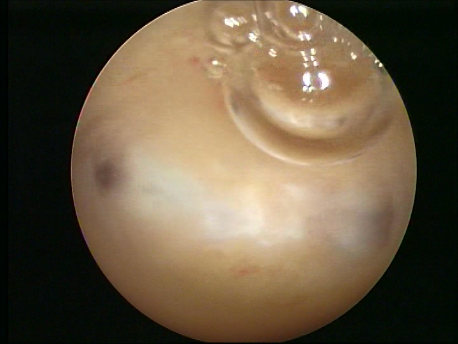 hysteroscopic surgery - 13 - picture after adhesiolyis following 2 months of hormone therapy