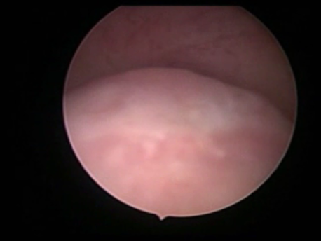 hysteroscopic surgery - 14 - large submucous fibroid