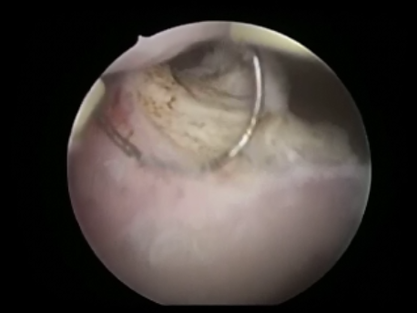 hysteroscopic surgery - 15 - fibroid being resected out
