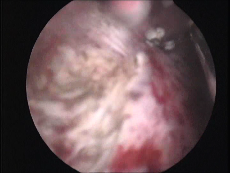 hysteroscopic surgery - 19 - hysteroscopic resection of a type 2 fibroid