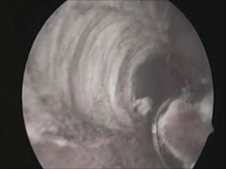 hysteroscopic surgery - 20 - transcervical resection of the endometrium for menorrhagia