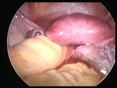 hysteroscopic surgery - 4 - T shaped uterine cavity