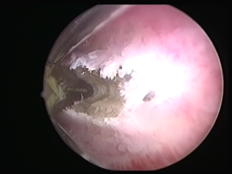 hysteroscopic surgery - 5 - broad fundus of a T shaped uterus