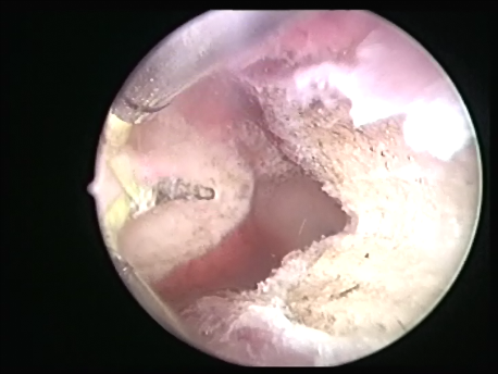 hysteroscopic surgery - 7 - final view of an expanded uterine cavity