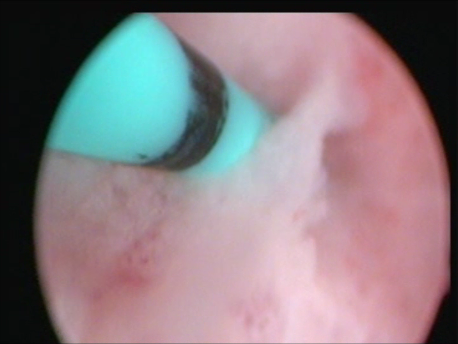 hysteroscopic surgery - 8 - hysteroscopic tubal cannulation