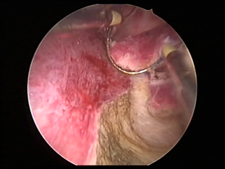 hysteroscopic surgery - TCRE