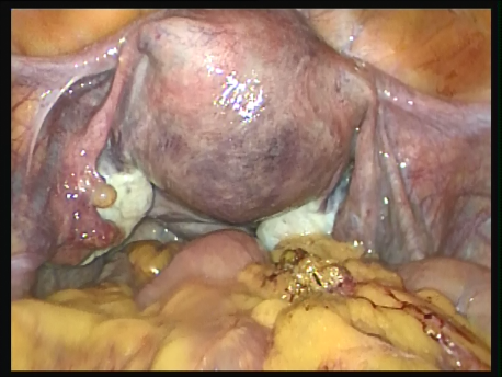 infertility - 1 - view of normal uterus Fallopian tubes and ovaries