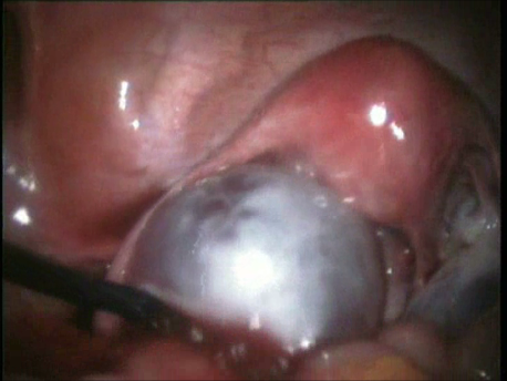 infertility - 2 - large ovarian cysts