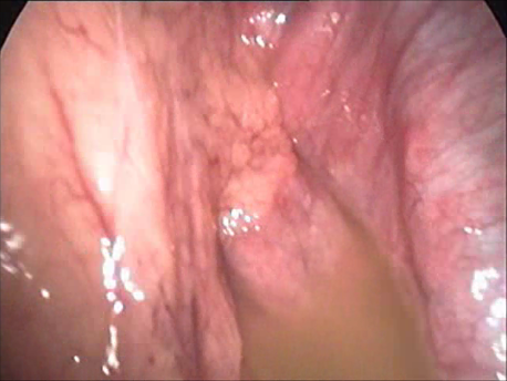 infertility - 7 - laparoscopic view of severe pelvic infection