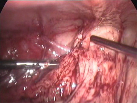 infertility - 8 - dense adhesions following pelvic infection