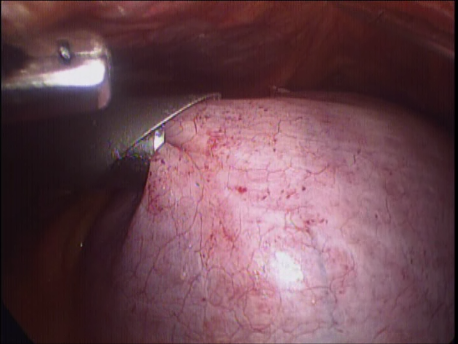 laparoscopic hysterectomy - 11 morcellating the large uterus
