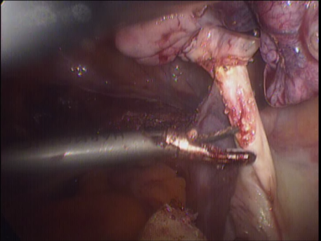 laparoscopic hysterectomy - 12 removing the ovariesand Fallopian tubes