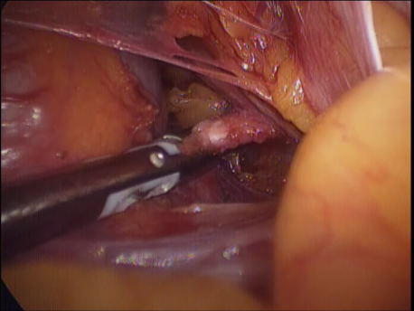 laparoscopic hysterectomy - 3 cauterizing the uterine vessels at their origin from the internal iliac arteries