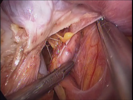 laparoscopic hysterectomy - 4 dissecting the ureter away from the surgical field