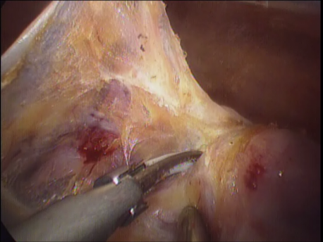 laparoscopic hysterectomy - 6 dissecting the bladder