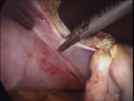 laparoscopic hysterectomy - 8 dissection of the uterine pedicles with the harmonic scalpel